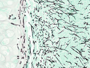 Image: Histopathologic image of pulmonary invasive aspergillosis in a patient with interstitial pneumonia. Autopsy material. Grocott's methenamine silver stain (Photo courtesy of Wikipedia). Image: Histopathologic image of pulmonary invasive aspergillosis in a patient with interstitial pneumonia. Autopsy material. Grocott's methenamine silver stain (Photo courtesy of Wikipedia).
